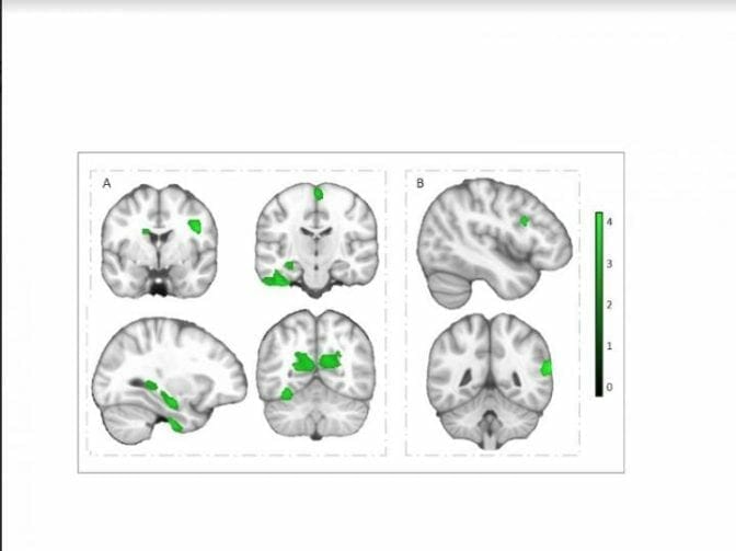 The brains of children with a better physical fitness possess a greater volume of gray matter