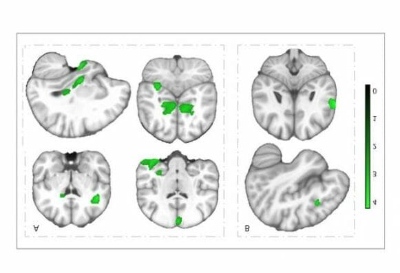 The brains of children with a better physical fitness possess a greater volume of gray matter